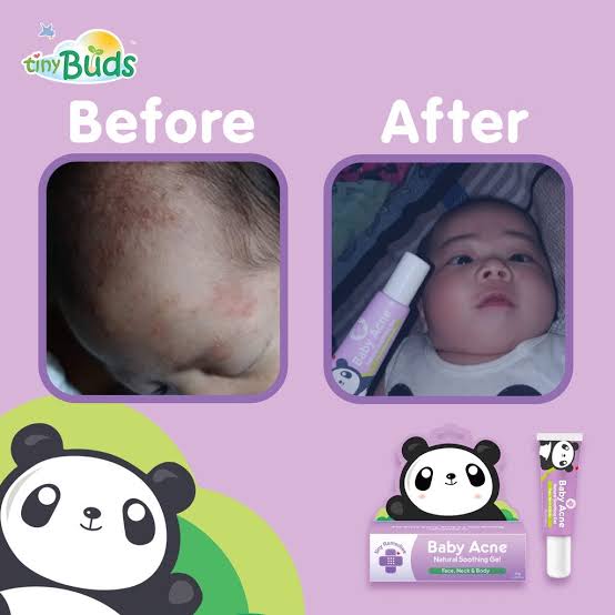 Tiny Buds Baby Acne Soothing gel (20g)