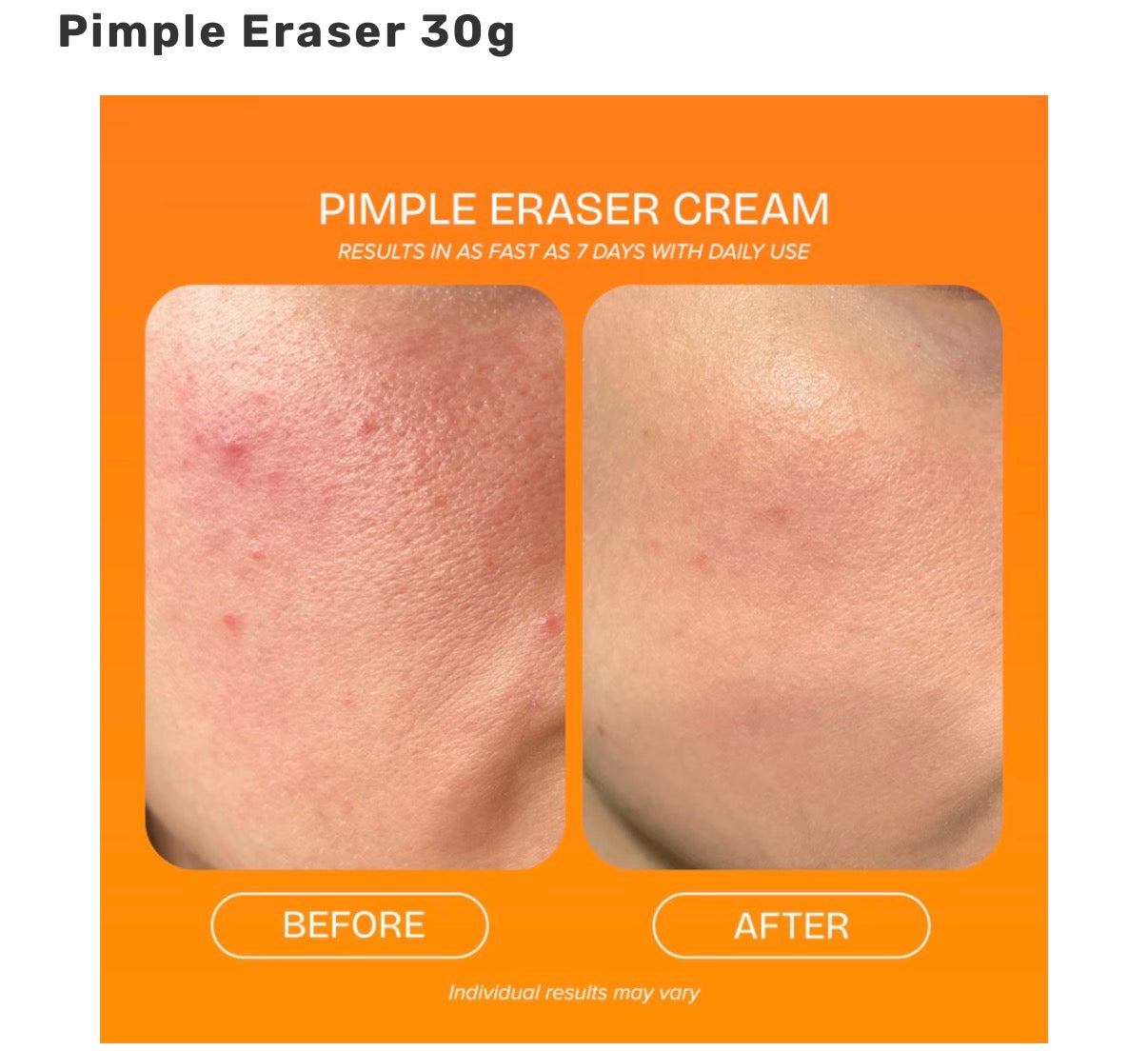 QuickFX Pimple Eraser Cream 30g