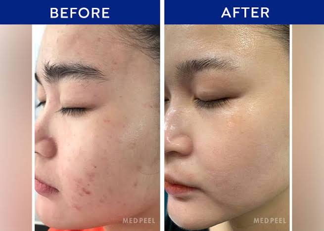 Medipeel Melanon X Cream 30ml