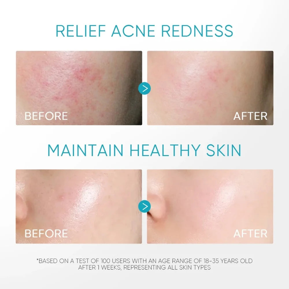 SKINTIFIC 5% Panthenol Acne Calming Water Gel 45g