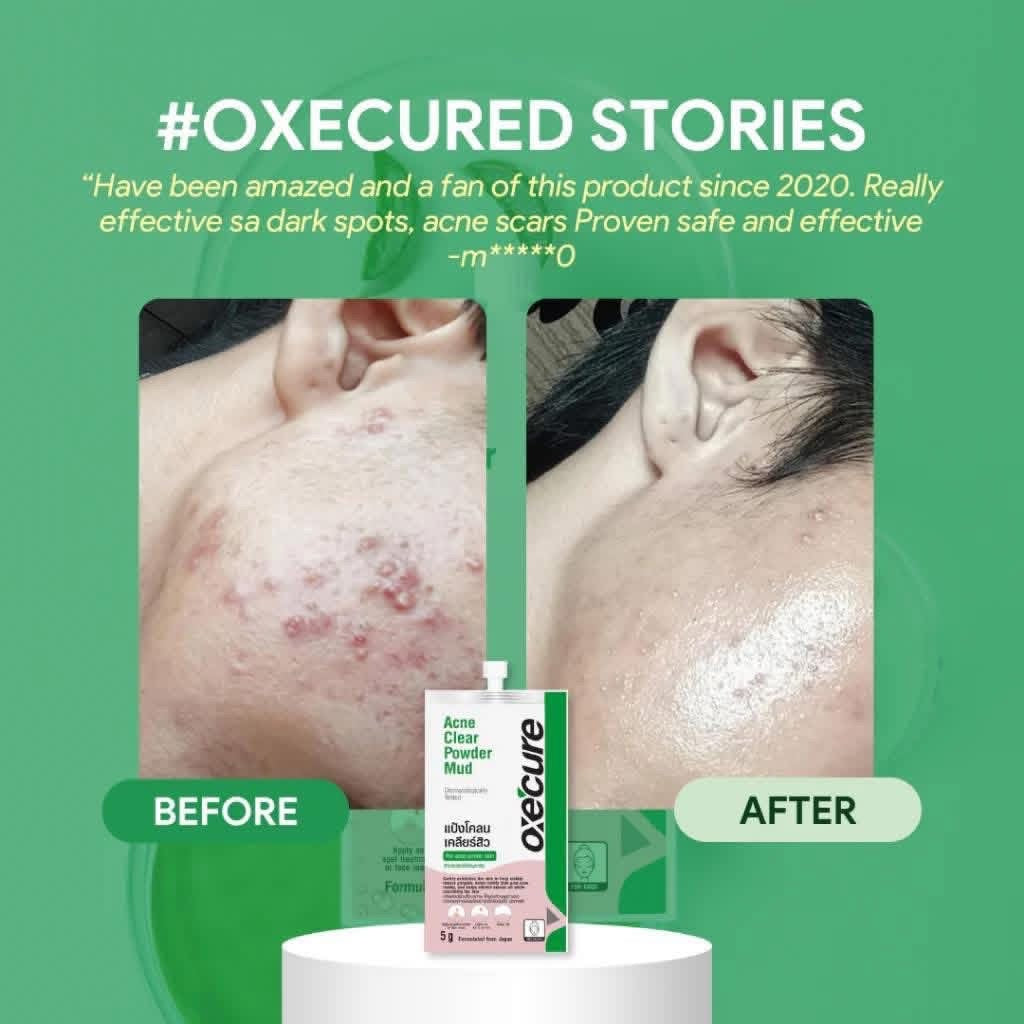 OXECURE
Acne Clear Powder Mud 7g