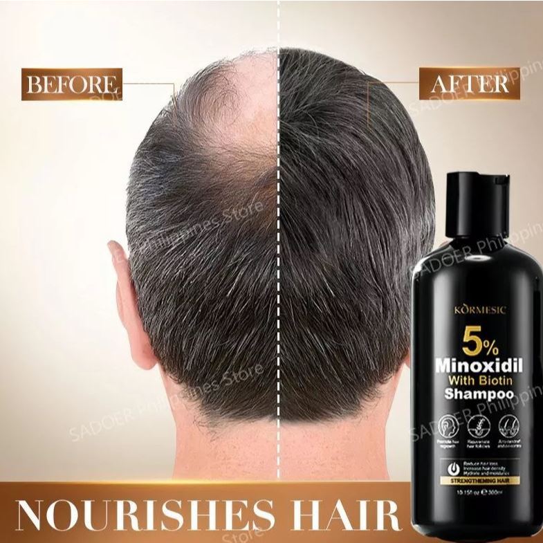KORMESIC 5% Minoxidil With Biotin Shampoo for Hairloss 300ml