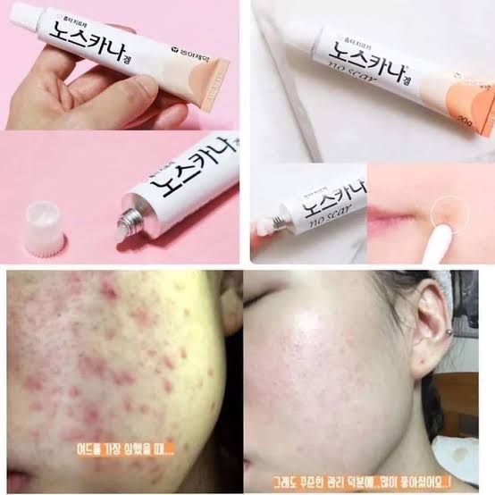 [NOSCARNA] No.1 Scar Treatment Noscarna Gel 10g