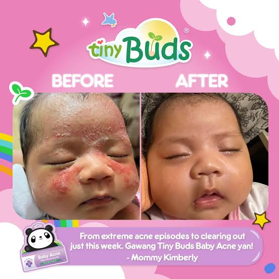 Tiny Buds Baby Acne Soothing gel (20g)