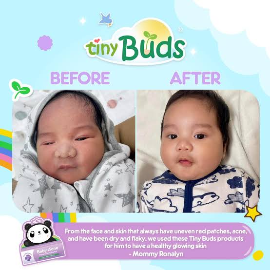 Tiny Buds Baby Acne Soothing gel (20g)